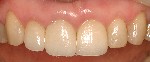 Porcelain-crowns-After-Image